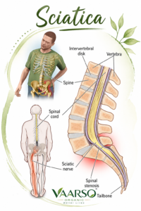 Sciatica pain from lower back to leg with Ayurvedic wellness and stretching